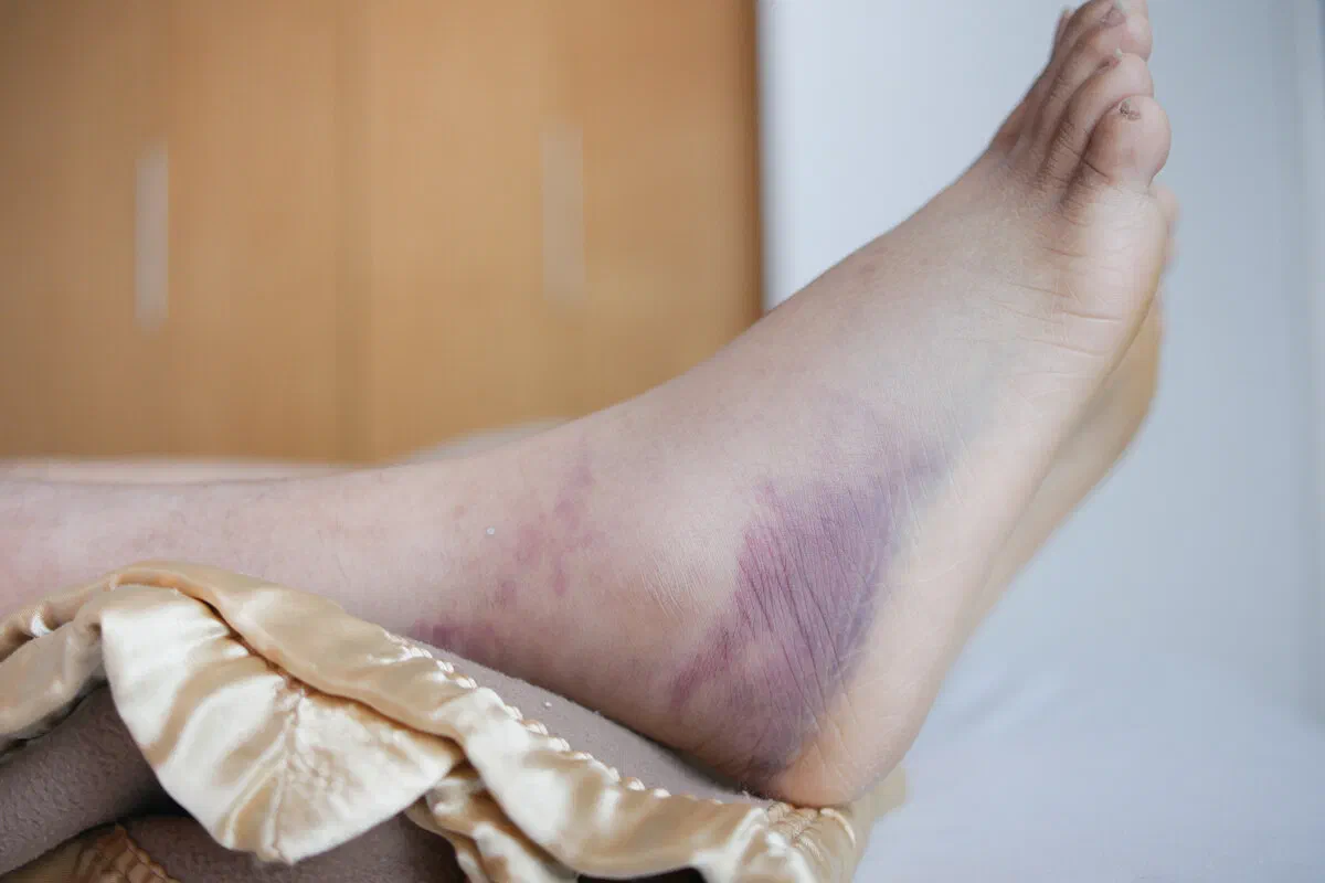 A bruised ankle
